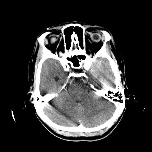 File:Choriocarcinoma of ovary with cerebral and pulmonary metastases (Radiopaedia 25983-26118 C+ arterial phase 45).jpg