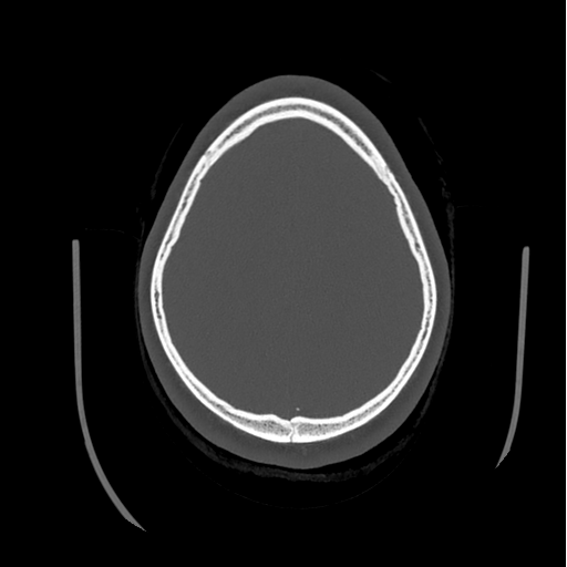 Choroid plexus papilloma extending into the cerebellopontine angle cistern (Radiopaedia 85941-101833 Axial bone window 74).png