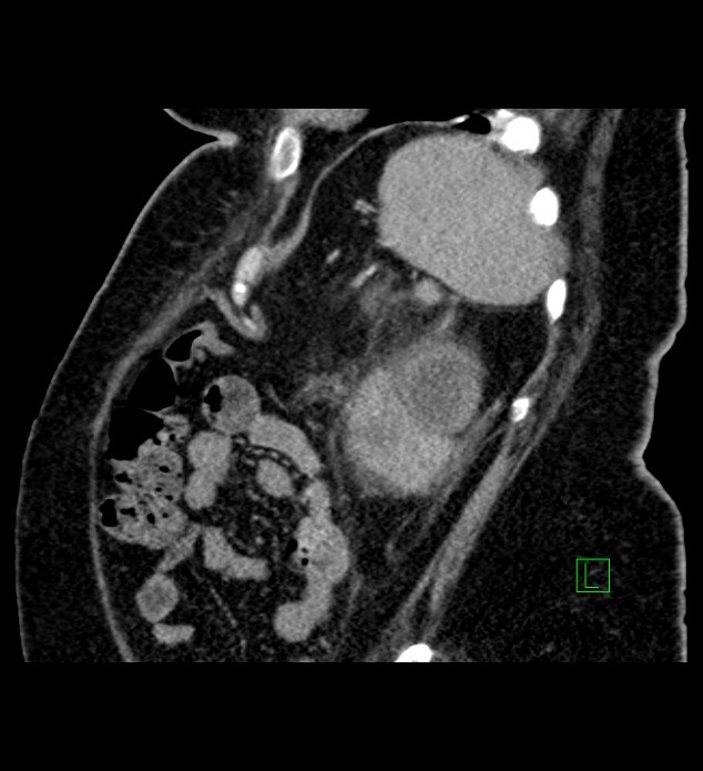 Chromophobe renal cell carcinoma (Radiopaedia 84239-99519 D 24).jpg