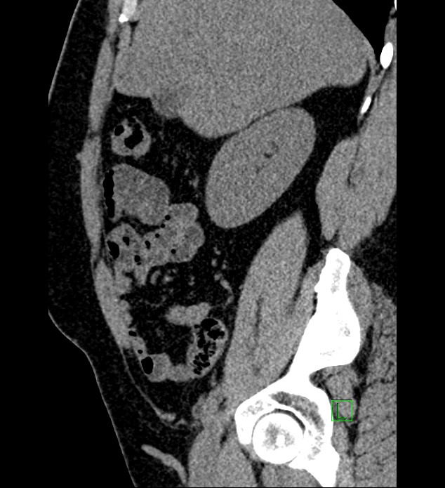 Chromophobe renal cell carcinoma (Radiopaedia 84286-99573 C 133).jpg