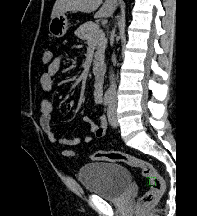 Chromophobe renal cell carcinoma (Radiopaedia 84286-99573 C 91).jpg