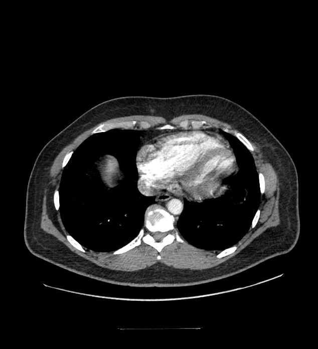 Chromophobe renal cell carcinoma (Radiopaedia 84337-99644 B 1).jpg