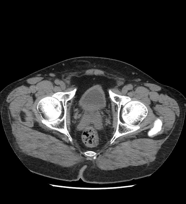 Chromophobe renal cell carcinoma (Radiopaedia 86879-103083 Axial non-contrast 125).jpg