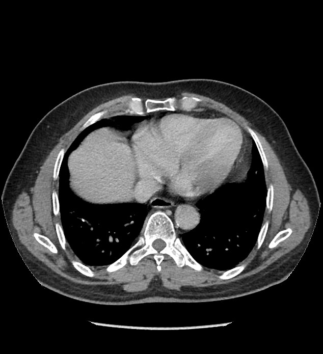 Chromophobe renal cell carcinoma (Radiopaedia 86879-103083 C 5).jpg