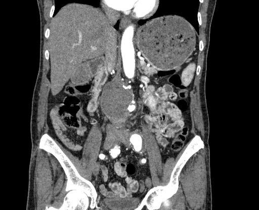 File:Chronic contained rupture of abdominal aortic aneurysm with extensive erosion of the vertebral bodies (Radiopaedia 55450-61901 D 36).jpg