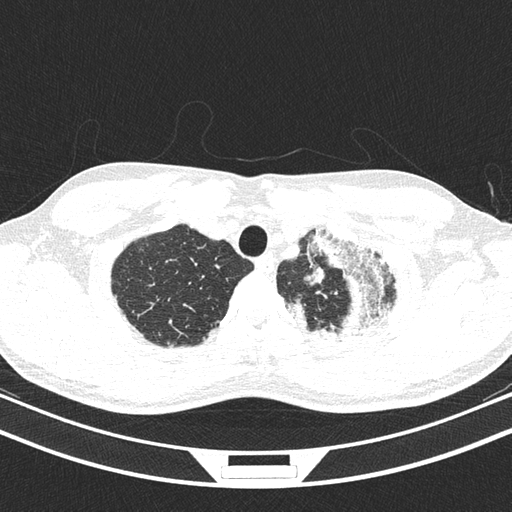 File:Chronic eosinophilic pneumonia (Radiopaedia 39331-41587 Axial lung window 8).png