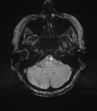 Chronic hypertensive encephalopathy (Radiopaedia 72844-83495 Axial SWI magnitude 14).png