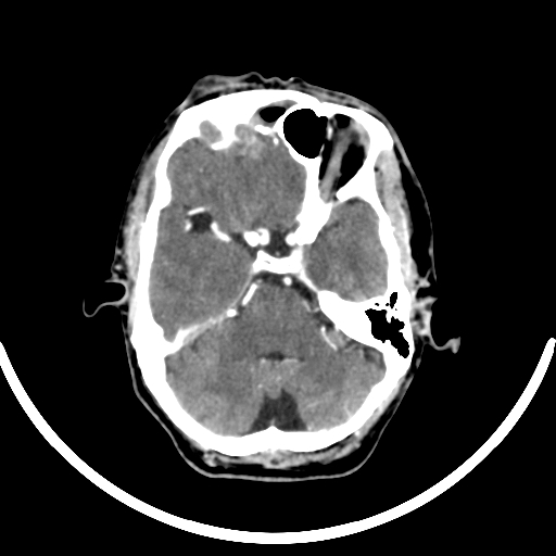 Chronic invasive fungal sinusitis with intraorbital and intracranial extension (Radiopaedia 56387-63046 B 120).jpg