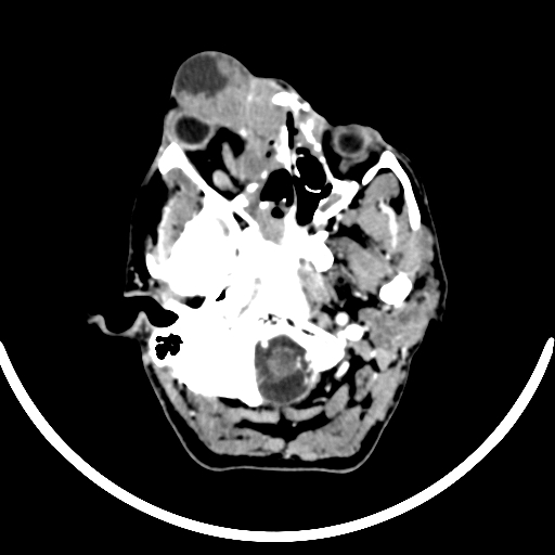 Chronic invasive fungal sinusitis with intraorbital and intracranial extension (Radiopaedia 56387-63046 B 75).jpg