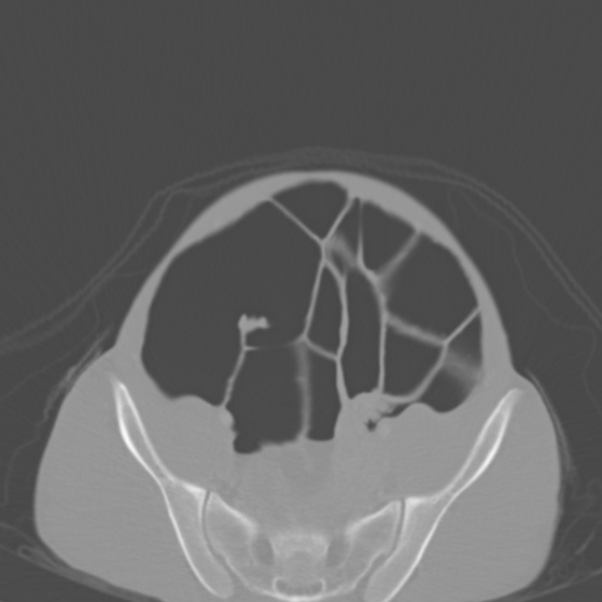Chronic large bowel pseudo-obstruction (Radiopaedia 43181-46492 Axial bone window 135).jpg