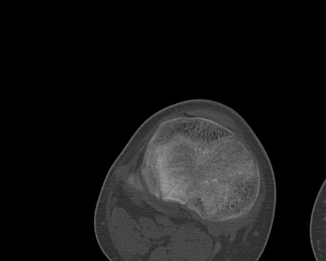 Chronic ostemyelitis of the femur with long sinus tract (Radiopaedia 74947-85982 Axial bone window 238).jpg