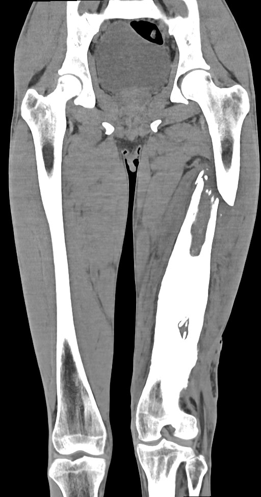 Chronic osteomyelitis (with sequestrum) (Radiopaedia 74813-85822 E 30).jpg