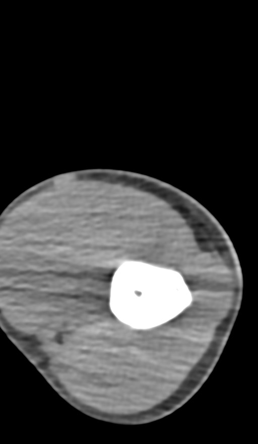 Chronic osteomyelitis of the distal humerus (Radiopaedia 78351-90971 Axial non-contrast 56).jpg