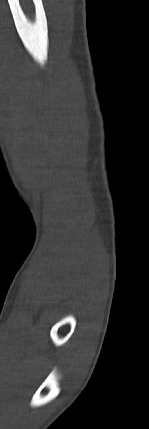Chronic osteomyelitis of the distal humerus (Radiopaedia 78351-90971 Sagittal bone window 35).jpg