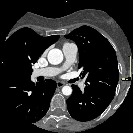 Chronic pulmonary embolism (Radiopaedia 73073-85094 Axial C+ CTPA 70).jpg