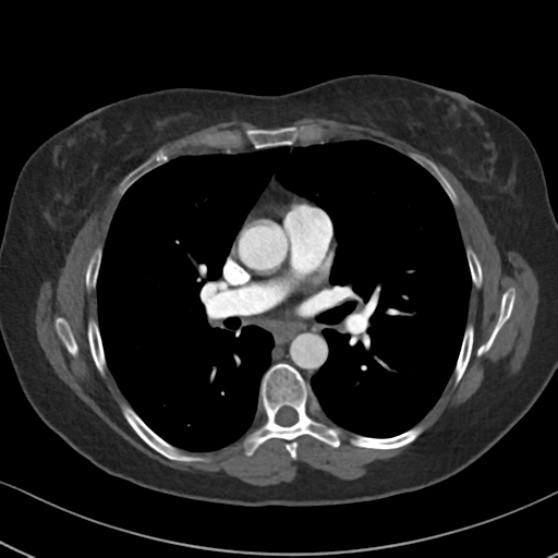 Chronic pulmonary embolus (Radiopaedia 39129-41341 Axial C+ CTPA 51).png