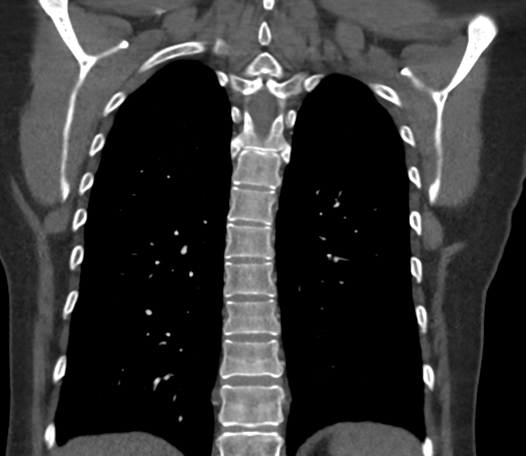 Chronic pulmonary embolus (Radiopaedia 39129-41341 Coronal C+ CTPA 64).png