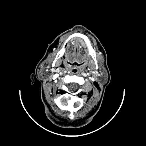 File:Chronic submandibular abscess (Radiopaedia 21738-21718 A 14).jpg