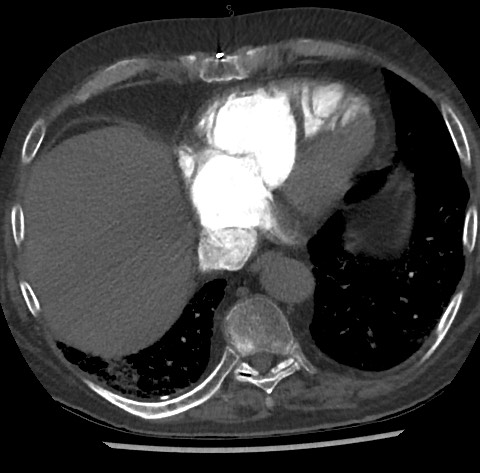 File:Chronic thromboembolic pulmonary disease (Radiopaedia 90694-108119 Axial C+ CTPA 74).jpg