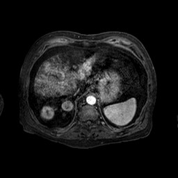Cirrhosis and hepatocellular carcinoma in the setting of hemochromatosis (Radiopaedia 75394-86594 Axial T1 C+ fat sat 141).jpg