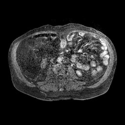 File:Cirrhosis and hepatocellular carcinoma in the setting of hemochromatosis (Radiopaedia 75394-86594 Axial T1 C+ fat sat 175).jpg