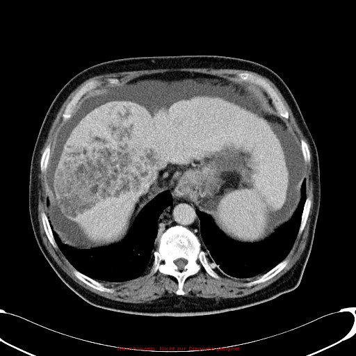 Cirrhosis and hepatocellular carcinoma in the setting of hemochromatosis (Radiopaedia 75394-86595 B 21).jpg