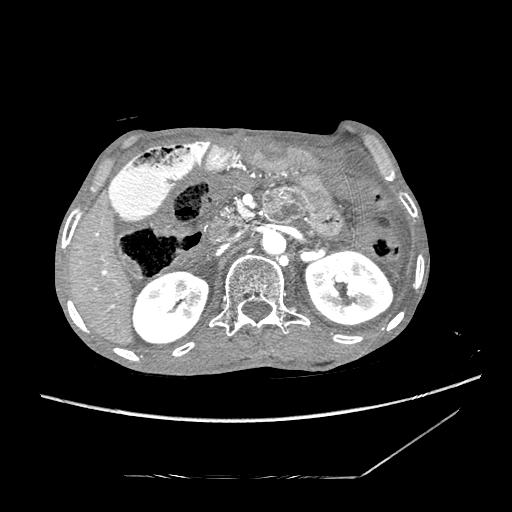Closed-loop obstruction due to peritoneal seeding mimicking internal hernia after total gastrectomy (Radiopaedia 81897-95864 A 46).jpg