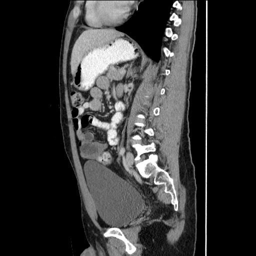Closed-loop small bowel obstruction (Radiopaedia 73713-84509 B 100).jpg