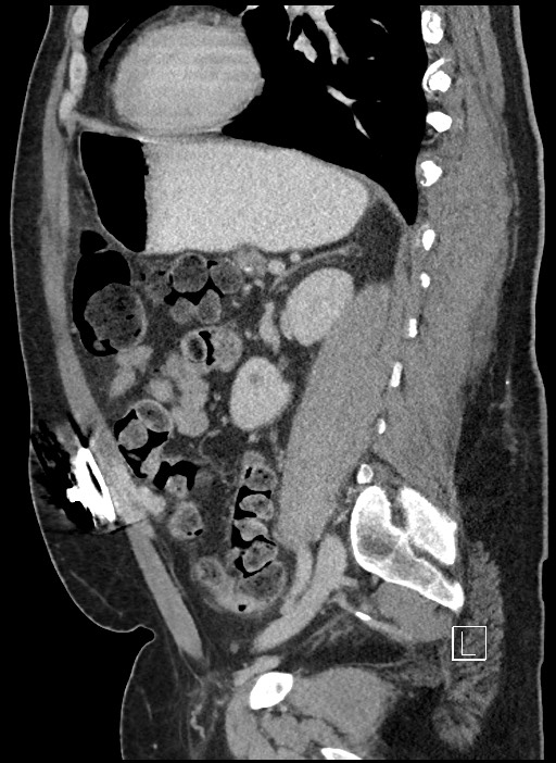 Closed loop obstruction - internal hernia into nephrectomy bed (Radiopaedia 59867-67320 C 30).jpg