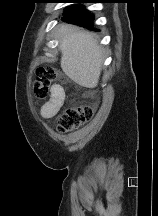 Closed loop obstruction - internal hernia into nephrectomy bed (Radiopaedia 59867-67320 C 99).jpg