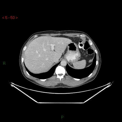 File:Closed loop obstruction and appendicular stump mucocele (Radiopaedia 54014-61158 A 15).jpg