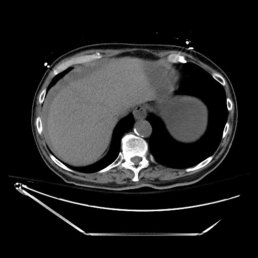 File:Closed loop obstruction due to adhesive band, resulting in small bowel ischemia and resection (Radiopaedia 83835-99023 Axial non-contrast 27).jpg