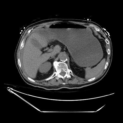 File:Closed loop obstruction due to adhesive band, resulting in small bowel ischemia and resection (Radiopaedia 83835-99023 Axial non-contrast 42).jpg