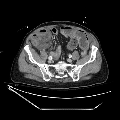 File:Closed loop obstruction due to adhesive band, resulting in small bowel ischemia and resection (Radiopaedia 83835-99023 D 113).jpg