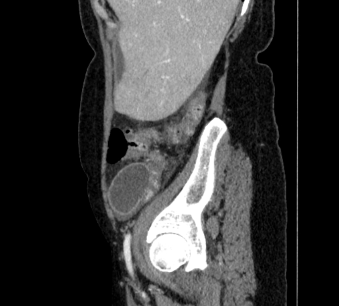 Closed loop small bowel obstruction (Radiopaedia 71211-81508 C 12).jpg