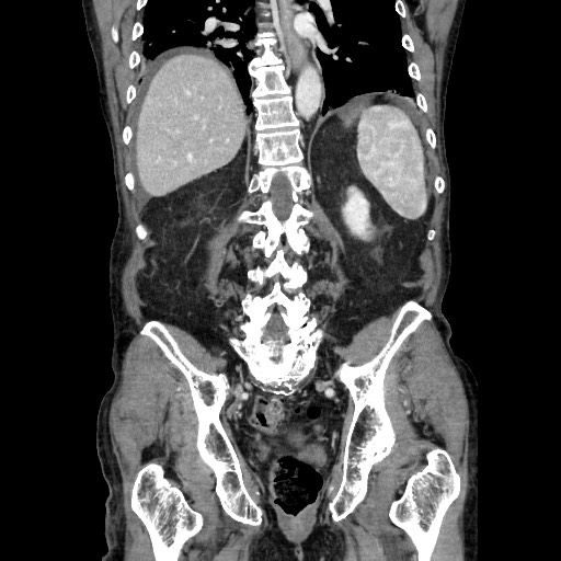 File:Closed loop small bowel obstruction - adhesive disease and hemorrhagic ischemia (Radiopaedia 86831-102990 B 92).jpg
