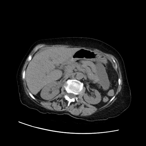 Closed loop small bowel obstruction due to adhesive band, with intramural hemorrhage and ischemia (Radiopaedia 83831-99017 Axial non-contrast 60).jpg