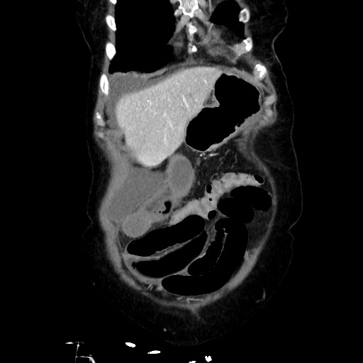 Closed loop small bowel obstruction due to adhesive band, with intramural hemorrhage and ischemia (Radiopaedia 83831-99017 C 28).jpg