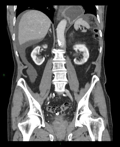 Closed loop small bowel obstruction with ischemia (Radiopaedia 84180-99456 B 26).jpg