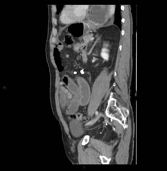 File:Closed loop small bowel obstruction with ischemia (Radiopaedia 84180-99456 C 61).jpg
