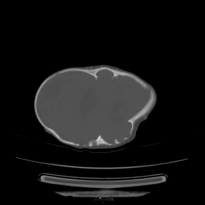 Cloverleaf skull (Radiopaedia 91901-109710 Axial bone window 118).jpg