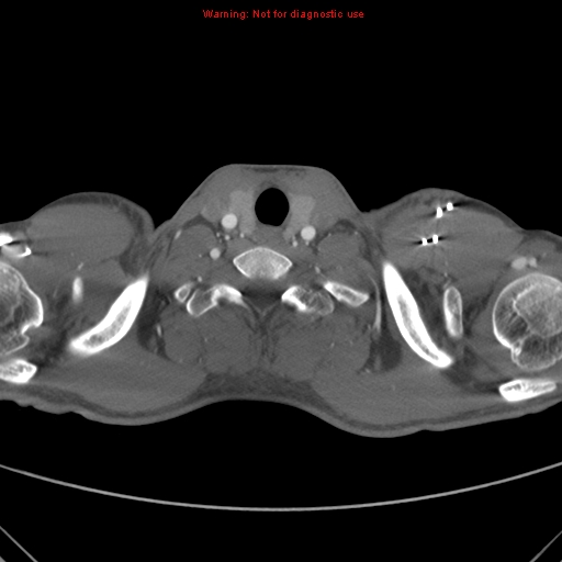File:Coarctation of the aorta (Radiopaedia 9434-10118 A 2).jpg