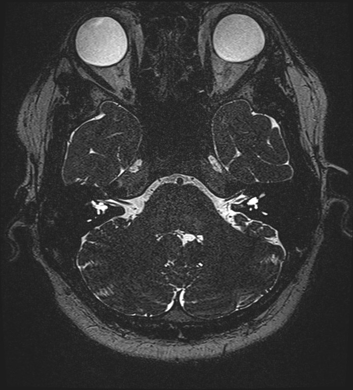 Cochlear incomplete partition type III associated with hypothalamic hamartoma (Radiopaedia 88756-105498 Axial T2 75).jpg