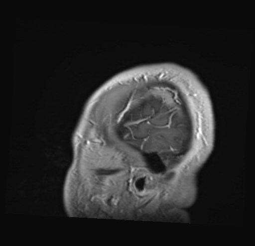 File:Cochlear incomplete partition type III associated with hypothalamic hamartoma (Radiopaedia 88756-105498 Sagittal T1 C+ 5).jpg