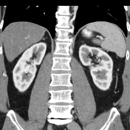 File:Collateral circulation following left renal vein thrombosis (Radiopaedia 17319-17013 renal cortical phase 8).jpg