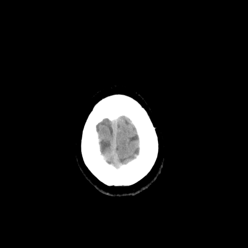 File:Colloid cyst (large) (Radiopaedia 34415-35734 Axial non-contrast 54).png
