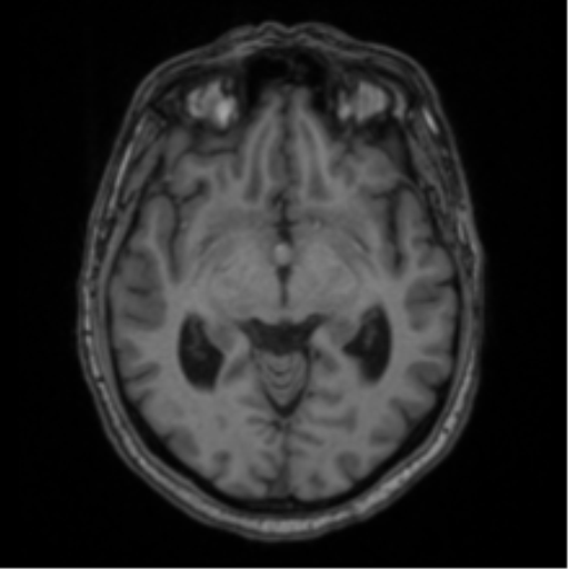 File:Colloid cyst of the third ventricle (Radiopaedia 86571-102662 Axial T1 35).png