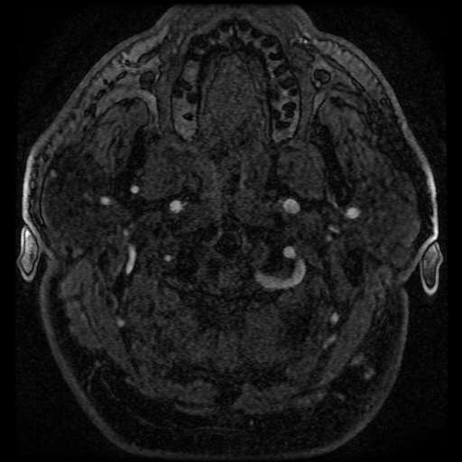 File:Colloid cyst with anterior communicating artery aneurysm (Radiopaedia 33901-35091 Axial MRA 16).jpg
