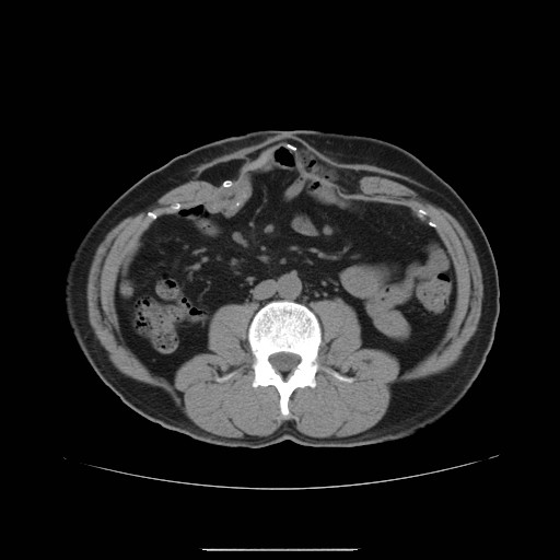 File:Colocutaneous fistula in Crohn's disease (Radiopaedia 29586-30093 Axial non-contrast 7).jpg
