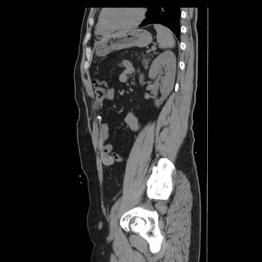 File:Colocutaneous fistula in Crohn's disease (Radiopaedia 29586-30093 C 42).jpg
